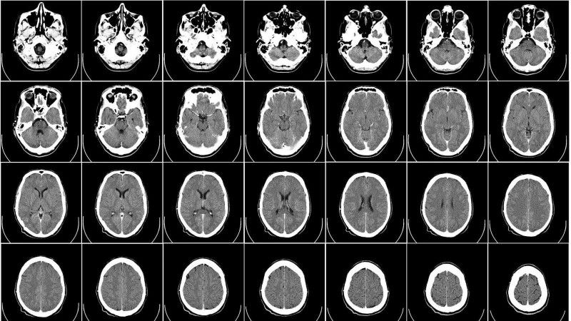 МРТ головного мозга: в каких случаях проводится E31fe3c85160a87ec4fcccc60538e889